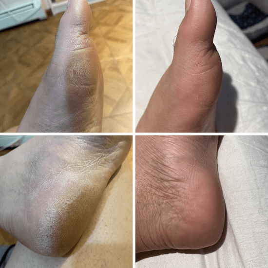 Melcora™ Callus Remover - Melcora
