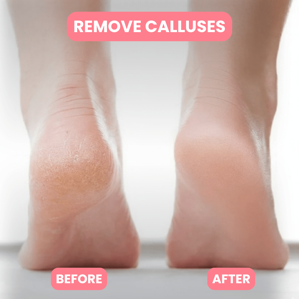 Melcora™ Callus Remover - Melcora
